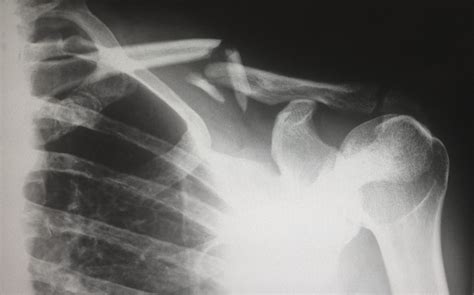 Clavicle Fracture Fixation & Surgery