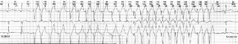 Pacemaker Mediated Tachycardia Interpolated Into Ventricular Tachycardia Download Scientific