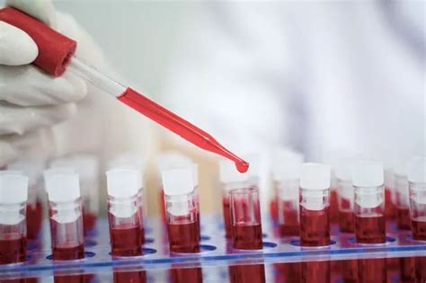 Hiv Diagnoses For Heterosexual People Overtake Those Of Gay And Bisexual Men For First Time In A