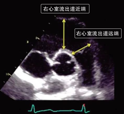 秒懂超声心动图的测量方法 好医术文章 好医术 赋能医生守护生命