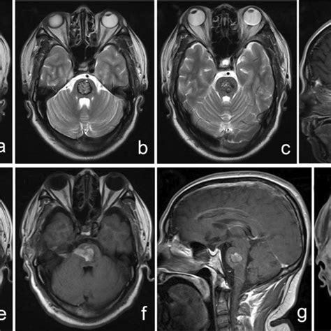 A D Preoperative Axial T2 Weighted Mr Images A C And Sagittal