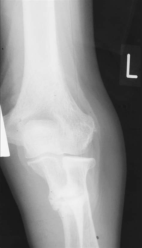 Bilateral Proximal Ulnar Looser Zones Image