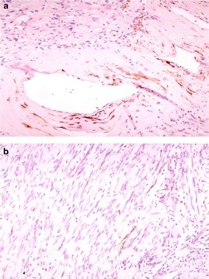 Keratin Expression In Schwannoma A Study Of Retroperitoneal And