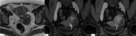 Subserosal Uterine Leiomyoma Pelvic Mri Of A 64 Year Old Woman A Download Scientific