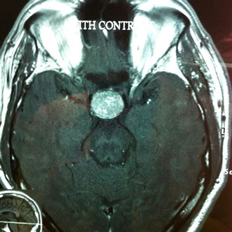 Non Functioning Pituitary Macroadenoma The Hku E Learning Platform In