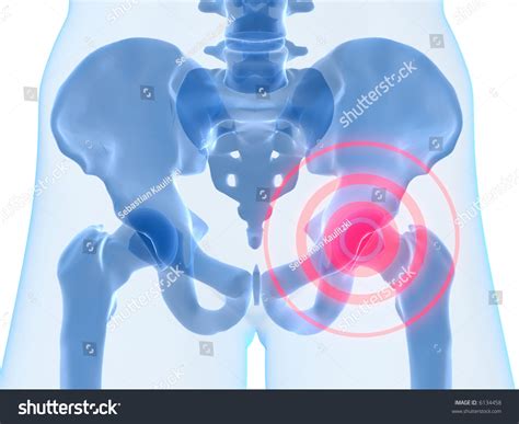 Hip Inflammation Stock Photo Shutterstock