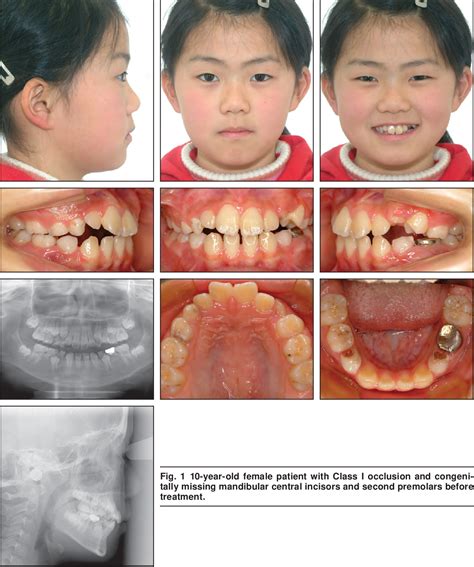 Figure From Autotransplantation Of Premolars In A Patient With