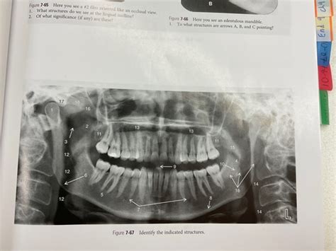 Chapter Radiology Panoramic Images Flashcards Quizlet