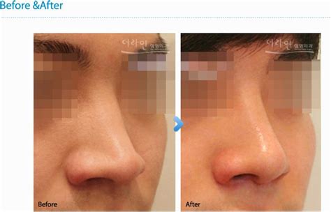 Bulbous Nose Job Before And After Male Rafaela Luckett