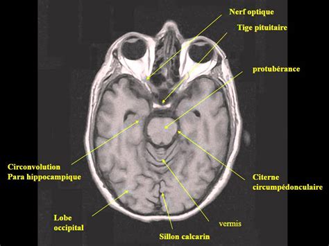 Neurologie Irm Coupes Axiales En Pond Ration T Youtube