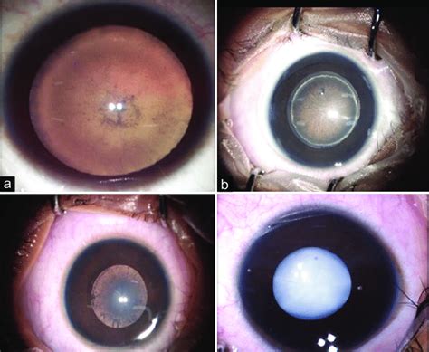 Anterior Segment Images Showing Different Morphology Of Cataracts In