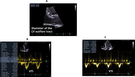 How To Use Echocardiography To Manage Patients With Shock Medicina Intensiva