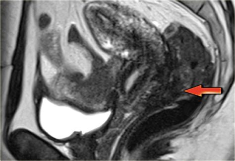 √ Uterus Endometriosis Ct Scan / Tumors Of The Uterine Corpus Clinical ...