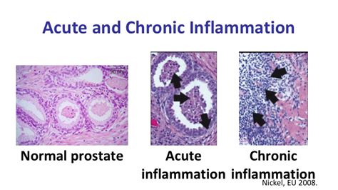 Prostate Inflammation And Prostate Cancer What Do I Need To Know