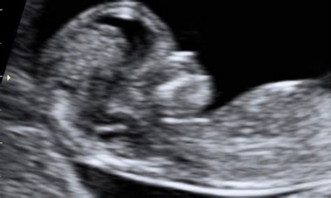 Scan Nuchal Translucency Nt Klinik Uzma