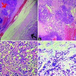 (a) Germ cell tumor with sharply demarcated dual morphology (red arrow ...