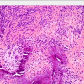 Calcifying Aponeurotic Fibroma Exhibiting Focal Calcification With