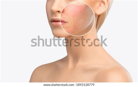 432 Skin Burn Laser Treatment Images, Stock Photos & Vectors | Shutterstock