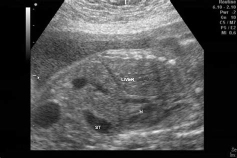 Diaphragmatic Hernia Ultrasound