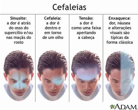 Aprenda Mais Sobre Alguns Tipos Comuns De Cefaléias Clínica Dr Hong Jin Pai Acupuntura Médica