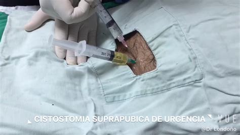 CISTOSTOMIA SUPRAPUBICA DE URGENCIA YouTube