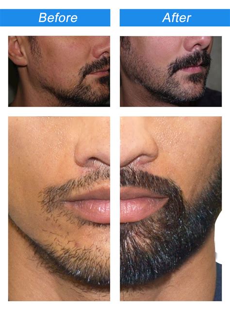 Beard Transplant In Iran Mustache Transplant Results Cost Mitramed