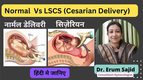 Normal Delivery V S LSCS Cesarian Dr Erum Sajid Clinic Best