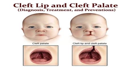 Cleft Lip and Cleft Palate (Diagnosis, Treatment, and Preventions ...