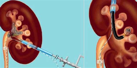 Tratamento De Rim E Pedra Urinária Métodos De Cirurgia E Remoção PuroMD