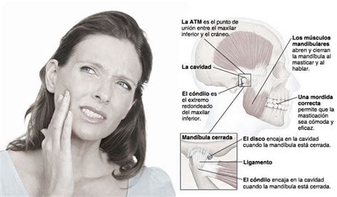 Articulaci N Temporomandibular Trastornos En La Atm Y Su Tratamiento