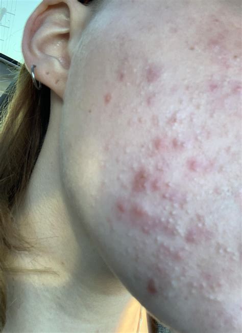 [acne] Help With Finding A Gentle Active To Treat My Closed Comedones And Rosacea Skin