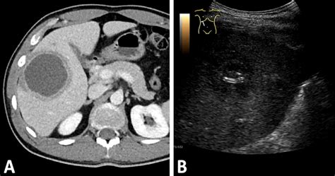 Amoebic Liver Necrosis In Contrast Enhanced Ultrasound [november 2023