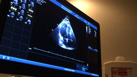 Had an echocardiogram on Friday to check my heart. This is part of it