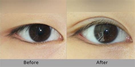 Non Incisional Double Eyelid Surgery Answer Plastic Surgery