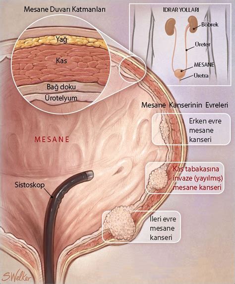 Mesane Kanseri I In Lk Kez Bir Gen Terapisi Fda Onay Ald Prof Dr