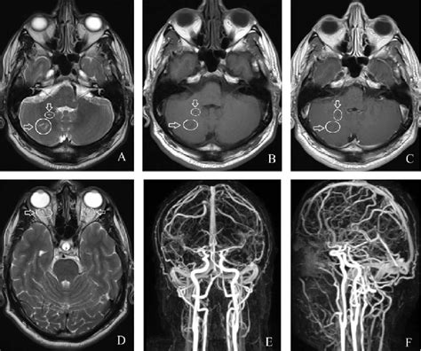 Magnetic Resonance Imaging A T2 Axial B T1 Axial C T1 Axial And