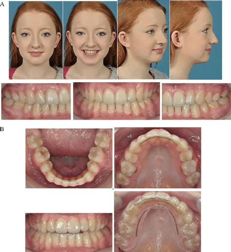 Post Orthodontic And Retention Phase A Extra And Intraoral Download Scientific Diagram