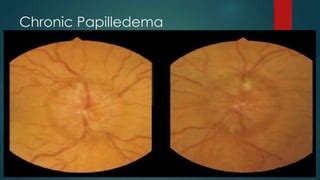 Papilledema vs papillitis with notes timothy zagada | PPT