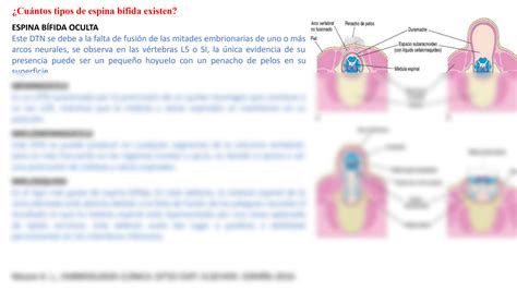 SOLUTION Cu Ntos Tipos De Espina B Fida Existen Pptx Studypool