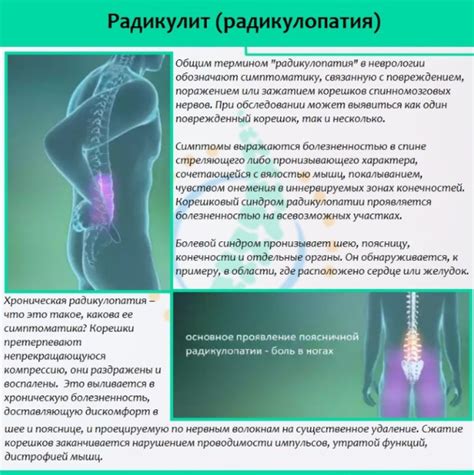 Лекарство от радикулита: пластырь, гомеопатия, свечи, миорелаксанты ...