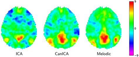 Default Mode Network Extracted Using Different Approaches Left The Download Scientific