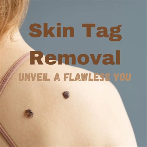 Skin Tag Removal: Erase the Negative with 7 Proven Methods - Only ...