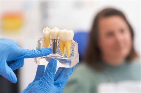 Los Mejores Consejos Para Cuidar Tus Implantes Dentales Consultorio