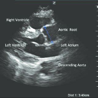 Parasternal long-axis view with white arrow showing a flap in the ...