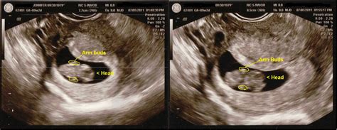 Early Ultrasound 9 weeks 2 days | Fun and Dysfunction