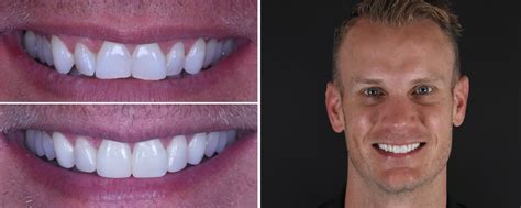 Before After Smile Makeover Gallery