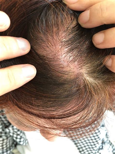 Dermatitis On Scalp