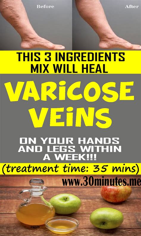 Heal Your Varicose Veins With This Great Mix Plan To Health