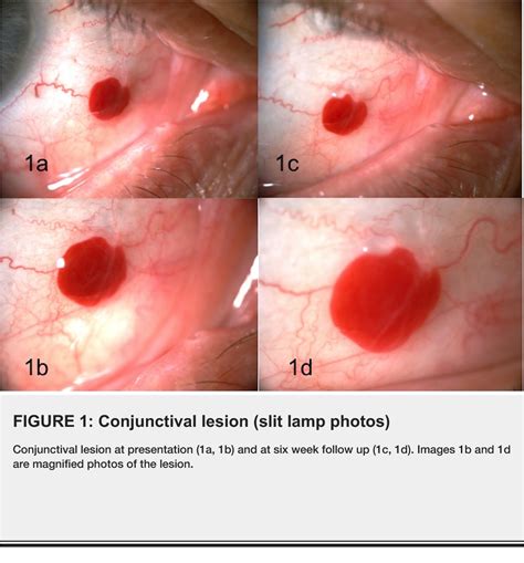 Figure 1 From Conjunctival Capillary Hemangioma Semantic Scholar