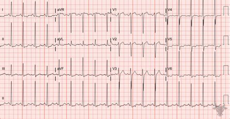 Left Ventricular Hypertrophy ECG Stampede